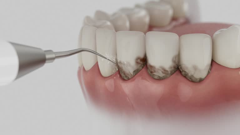 Trusted Wisdom Tooth Removal service in South Brooksville, FL - Dentist Open Now